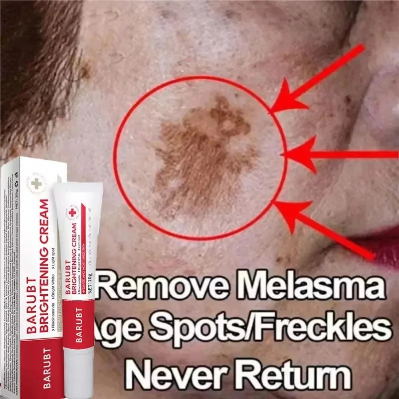 Whitening Freckles Face Cream Removal