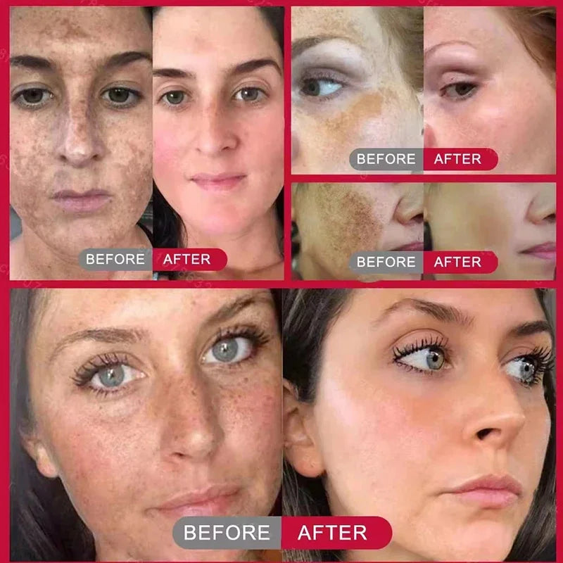 Whitening Freckles Face Cream Removal